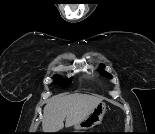 Acromioclavicular joint cyst (Radiopaedia 58455-65610 Coronal C+ arterial phase 33).jpg