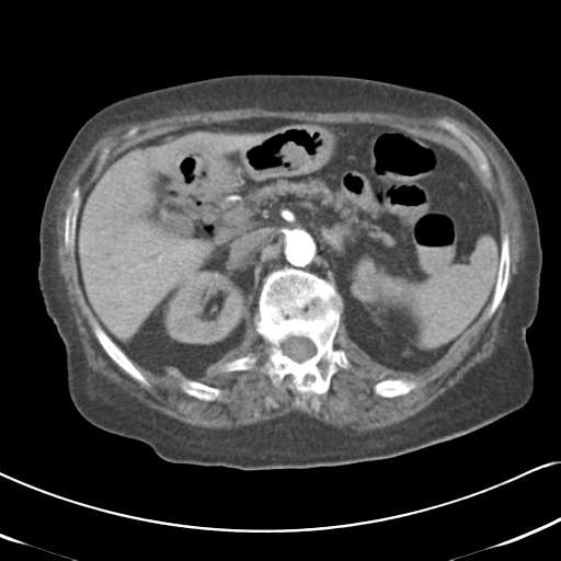 File:Active bleeding from duodenal ulcer with embolization (Radiopaedia 34216-35481 Axial C+ arterial phase 21).png