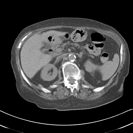 Active bleeding from duodenal ulcer with embolization (Radiopaedia 34216-35481 Axial non-contrast 23).png