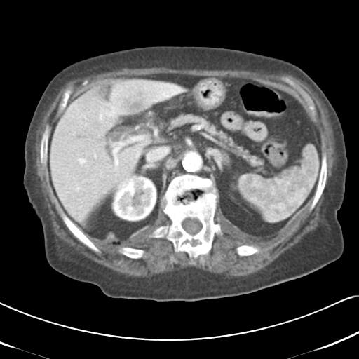 File:Active bleeding from duodenal ulcer with embolization (Radiopaedia 34216-35481 C 20).png