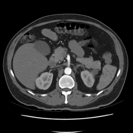 File:Active colonic bleed on CT (Radiopaedia 49765-55025 Axial C+ arterial phase 28).jpg