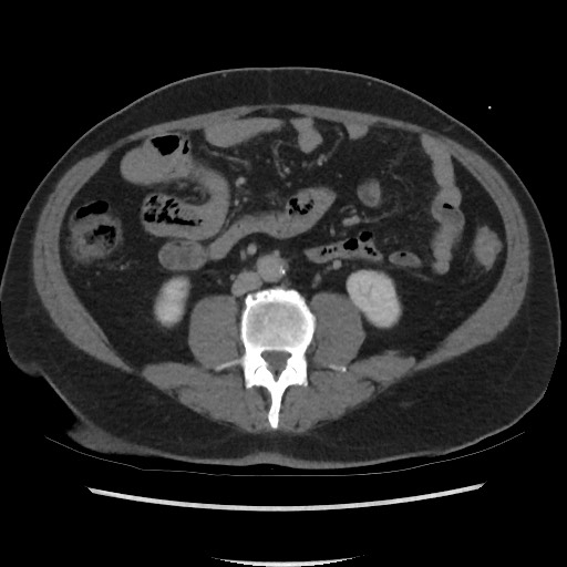 File:Active colonic bleed on CT (Radiopaedia 49765-55025 Axial C+ delayed 45).jpg