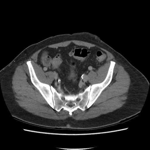 File:Active colonic bleed on CT (Radiopaedia 49765-55025 Axial C+ delayed 66).jpg