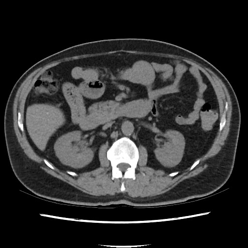 Active colonic bleed on CT (Radiopaedia 49765-55025 Axial non-contrast 32).jpg