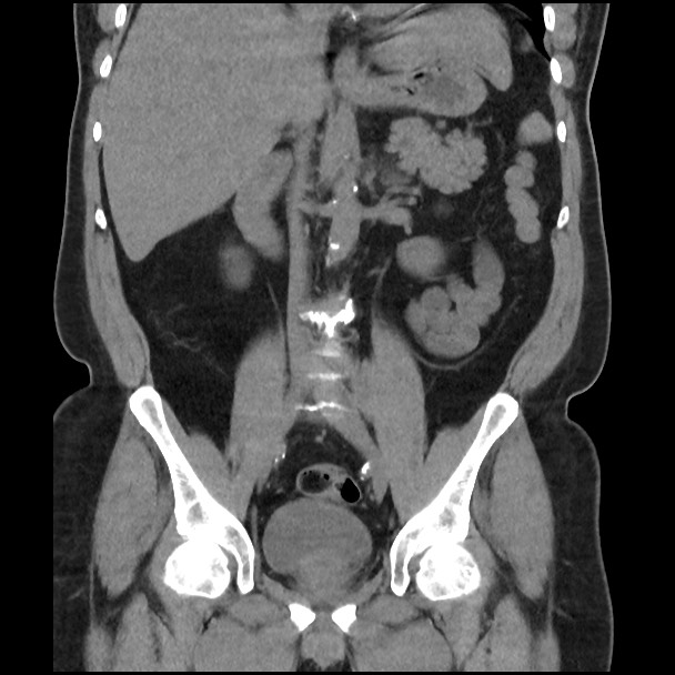 Active colonic bleed on CT (Radiopaedia 49765-55025 Coronal non-contrast 30).jpg