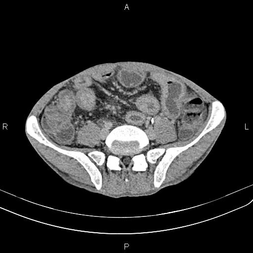 Active crohn disease (Radiopaedia 87133-103397 Axial C+ delayed 47).jpg