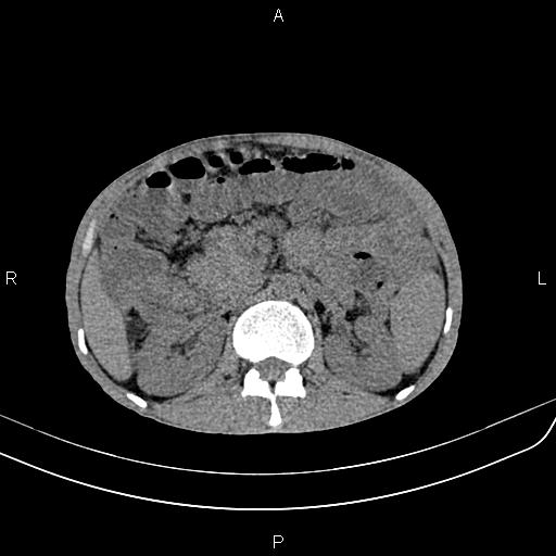 Active crohn disease (Radiopaedia 87133-103397 Axial non-contrast 38).jpg