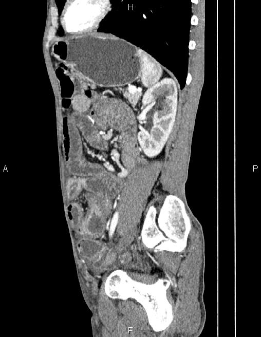 Active crohn disease (Radiopaedia 87133-103397 Sagittal C+ arterial phase 62).jpg