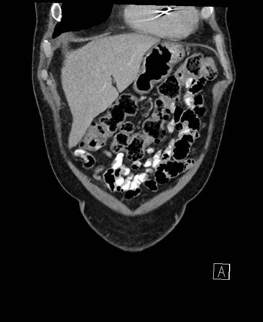 Active lower gastrointestinal bleeding - diverticular (Radiopaedia 61203-69106 Coronal C+ portal venous phase 27).jpg