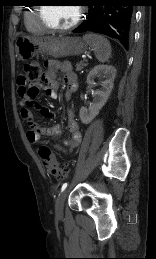 Active lower gastrointestinal bleeding - diverticular (Radiopaedia 61203-69106 Sagittal C+ arterial phase 51).jpg