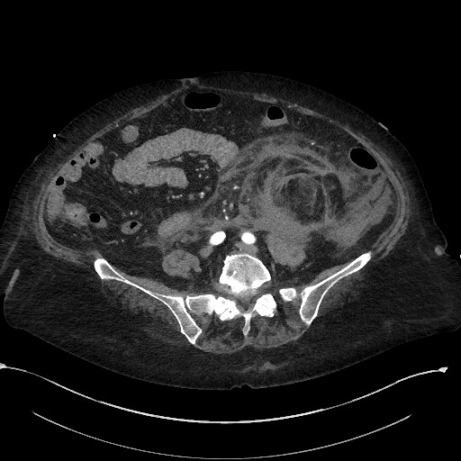 File:Active renal extravasation with large subcapsular and retroperitoneal hemorrhage (Radiopaedia 60975-68796 Axial C+ arterial phase 126).jpg