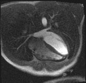 Active right ventricular cardiac sarcoidosis (Radiopaedia 55596-62100 Axial Dynamic perfusion scan MOCO 69).jpg