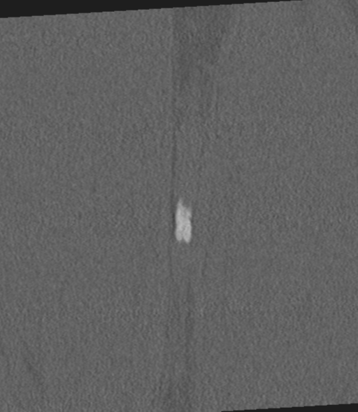 Acute L1 burst compression fracture (Radiopaedia 34430-35755 Coronal bone window 64).png