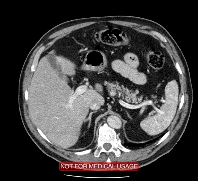 Acute aortic dissection - Stanford type A (Radiopaedia 40661-43285 Axial C+ portal venous phase 73).jpg