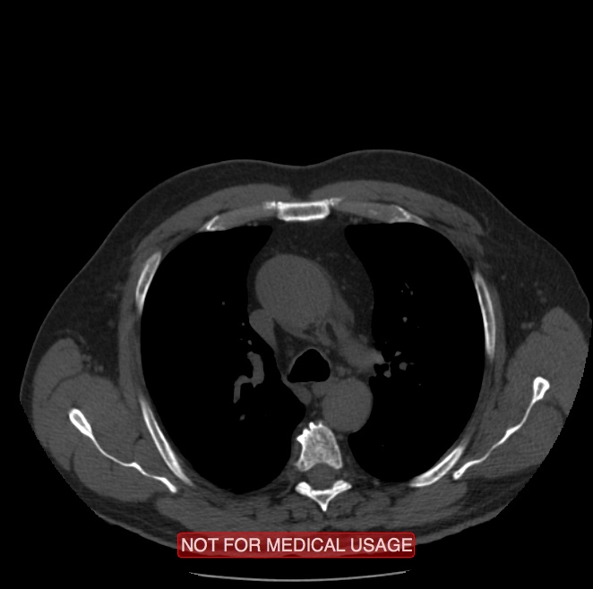 Acute aortic dissection - Stanford type A (Radiopaedia 40661-43285 Axial non-contrast 13).jpg