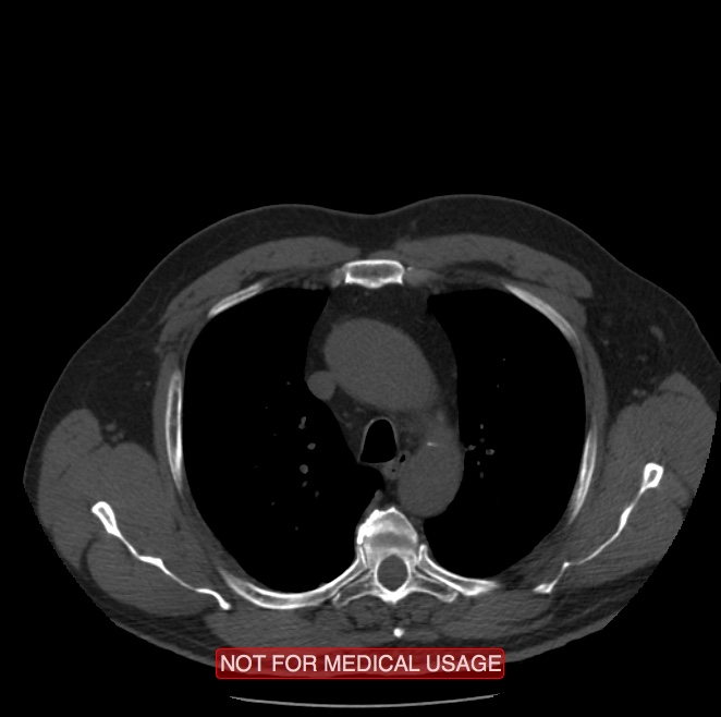 Acute aortic dissection - Stanford type A (Radiopaedia 40661-43285 Axial non-contrast 8).jpg