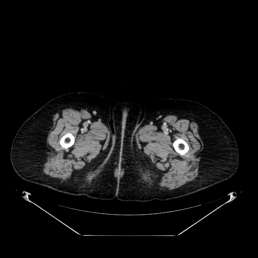 File:Acute appendicitis, heterotaxy syndrome (Radiopaedia 66884-76202 Axial 146).jpg