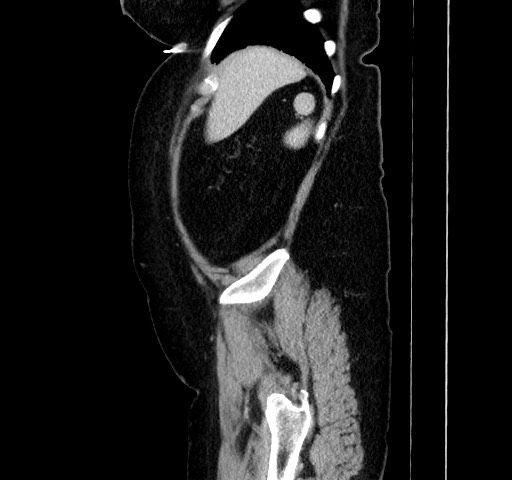 Acute appendicitis, heterotaxy syndrome (Radiopaedia 66884-76202 Sagittal C+ portal venous phase 29).jpg
