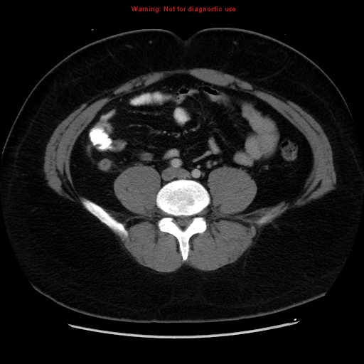 File:Acute appendicitis (Radiopaedia 12326-12607 Axial C+ portal venous phase 18).jpg