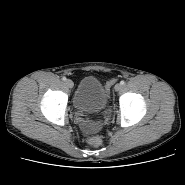 Acute appendicitis (Radiopaedia 27049-27227 Axial C+ portal venous phase 69).jpg