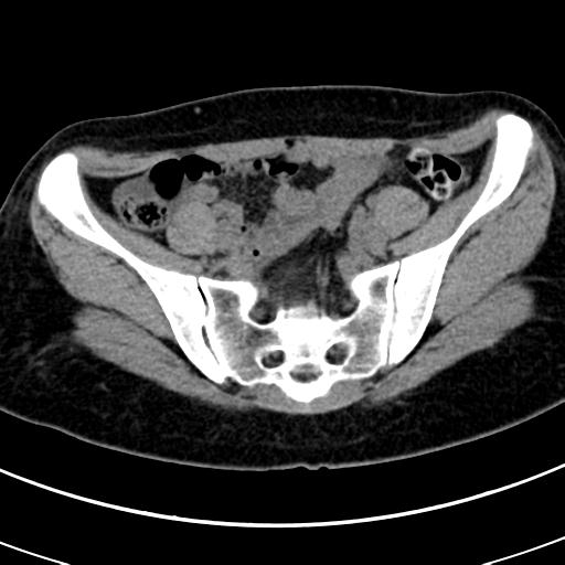 Acute appendicitis (Radiopaedia 30261-30888 Axial non-contrast 76).jpg