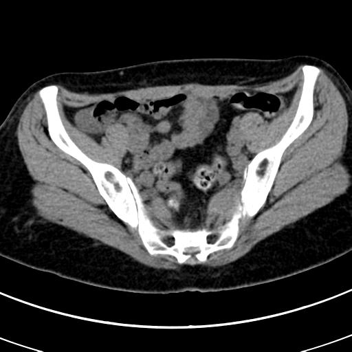 Acute appendicitis (Radiopaedia 30261-30888 Axial non-contrast 81).jpg