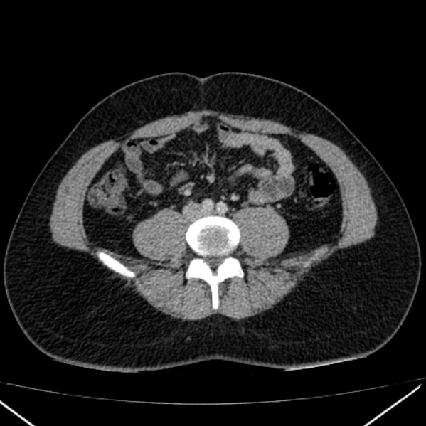 Acute appendicitis (Radiopaedia 38255-40270 Axial C+ portal venous phase 66).jpg