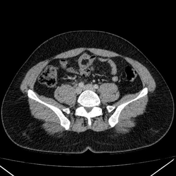 File:Acute appendicitis (Radiopaedia 38255-40270 Axial C+ portal venous phase 73).jpg