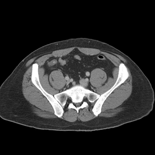 Acute appendicitis (Radiopaedia 48511-53463 Axial C+ portal venous phase 77).jpg