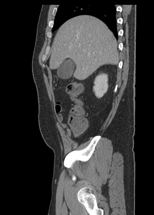 Acute appendicitis (Radiopaedia 48511-53463 Sagittal C+ portal venous phase 37).jpg