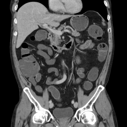 Acute appendicitis (Radiopaedia 66513-75790 Coronal C+ portal venous phase 33).jpg