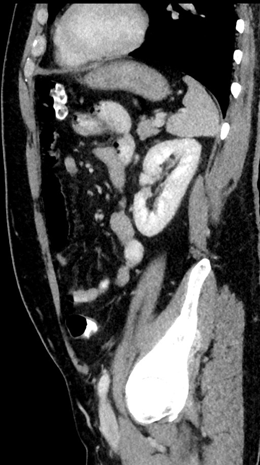 Acute appendicitis (Radiopaedia 77016-88960 Sagittal C+ portal venous phase 35).jpg