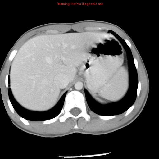 Acute appendicitis (Radiopaedia 8195-9045 Axial C+ portal venous phase 13).jpg