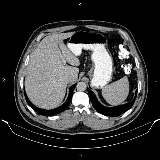 Acute appendicitis (Radiopaedia 84780-100240 Axial C+ portal venous phase 22).jpg