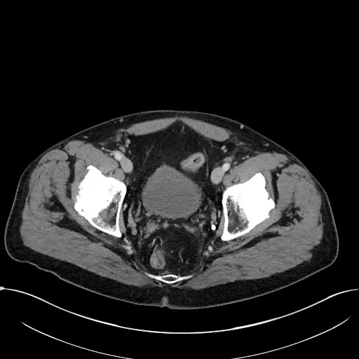 Acute appendicitis - large appendicoliths (Radiopaedia 61805-69820 Axial C+ portal venous phase 117).jpg