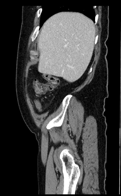 Acute appendicitis - large appendicoliths (Radiopaedia 61805-69820 Sagittal C+ portal venous phase 97).jpg