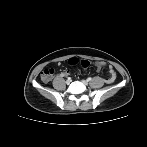 Acute appendicitis and COVID 19 pneumonia (Radiopaedia 76604-88380 Axial C+ portal venous phase 58).jpg