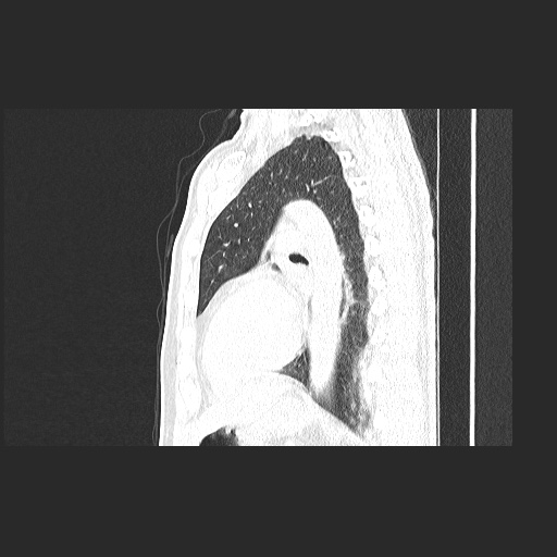 File:Acute appendicitis and COVID 19 pneumonia (Radiopaedia 76604-88380 Sagittal lung window 61).jpg