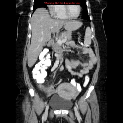 File:Acute appendicitis complicated by ovarian vein thrombophlebitis (Radiopaedia 16172-15851 Coronal C+ portal venous phase 35).jpg