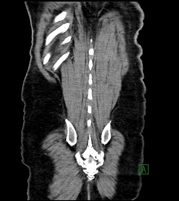Acute arterial mesenteric ischemia (Radiopaedia 78238-90828 Coronal C+ portal venous phase 81).jpg