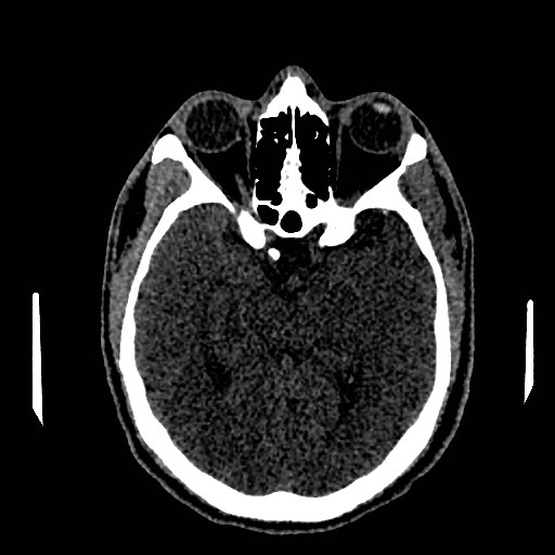 Acute basilar artery occlusion (Radiopaedia 43582-46985 Axial non-contrast 82).jpg