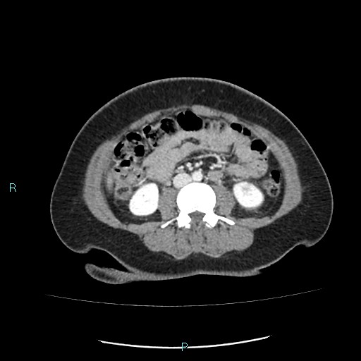 Acute bilateral pyelonephritis (Radiopaedia 37146-38881 Axial C+ portal venous phase 56).jpg