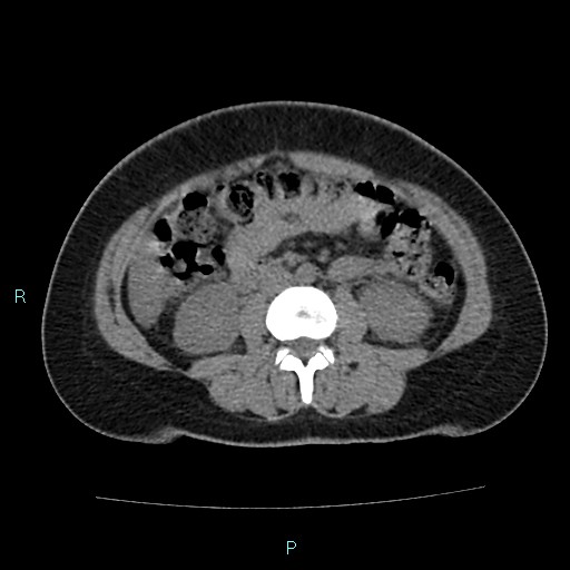 Acute bilateral pyelonephritis (Radiopaedia 37146-38881 Axial non-contrast 54).jpg
