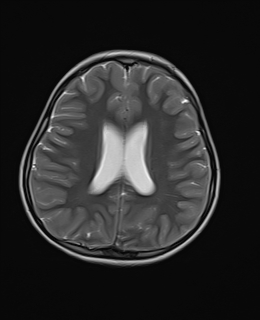 File:Acute cerebellar ataxia (Radiopaedia 61487-69446 Axial T2 15).jpg