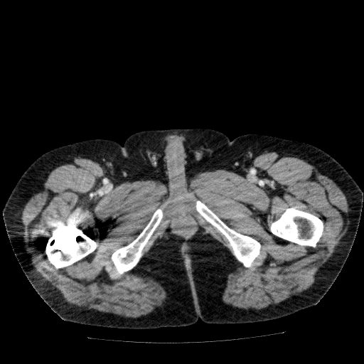 Acute cholecystitis and incidental left sided IVC (Radiopaedia 49352-54459 Axial C+ portal venous phase 169).jpg