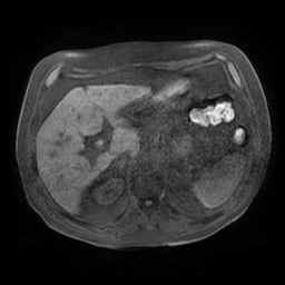 Acute cholecystitis complicated by pylephlebitis (Radiopaedia 65782-74915 Axial T1 fat sat 43).jpg