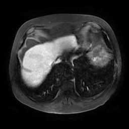 Acute cholecystitis complicated by pylephlebitis (Radiopaedia 65782-74915 Axial arterioportal phase T1 C+ fat sat 8).jpg