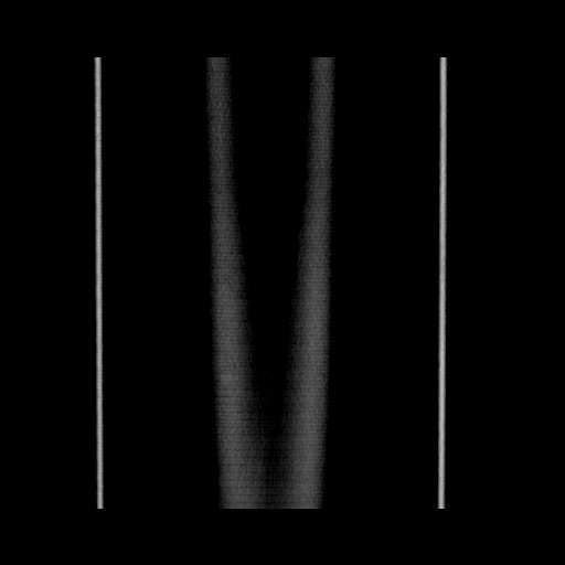 File:Acute cholecystitis with tensile fundus sign (Radiopaedia 71394-81723 Coronal non-contrast 139).jpg
