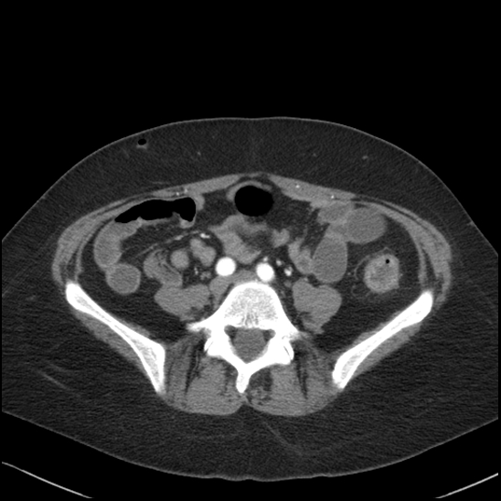 Acute colonic hemorrhage in ulcerative colitis (Radiopaedia 77415-89538 Axial C+ arterial phase 88).jpg