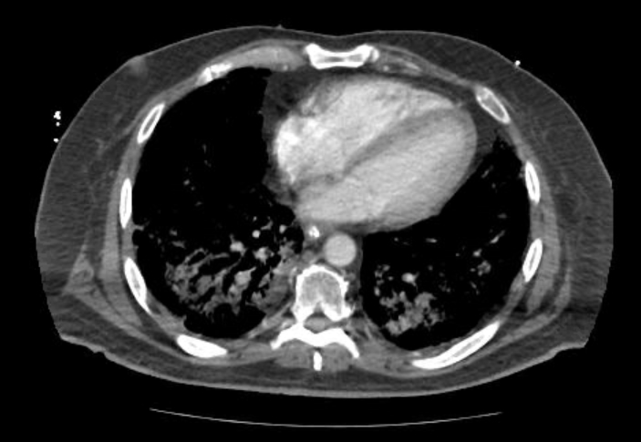 Acute cor pulmonale (ultrasound) (Radiopaedia 83508-98818 Axial C+ CTPA 53).jpg